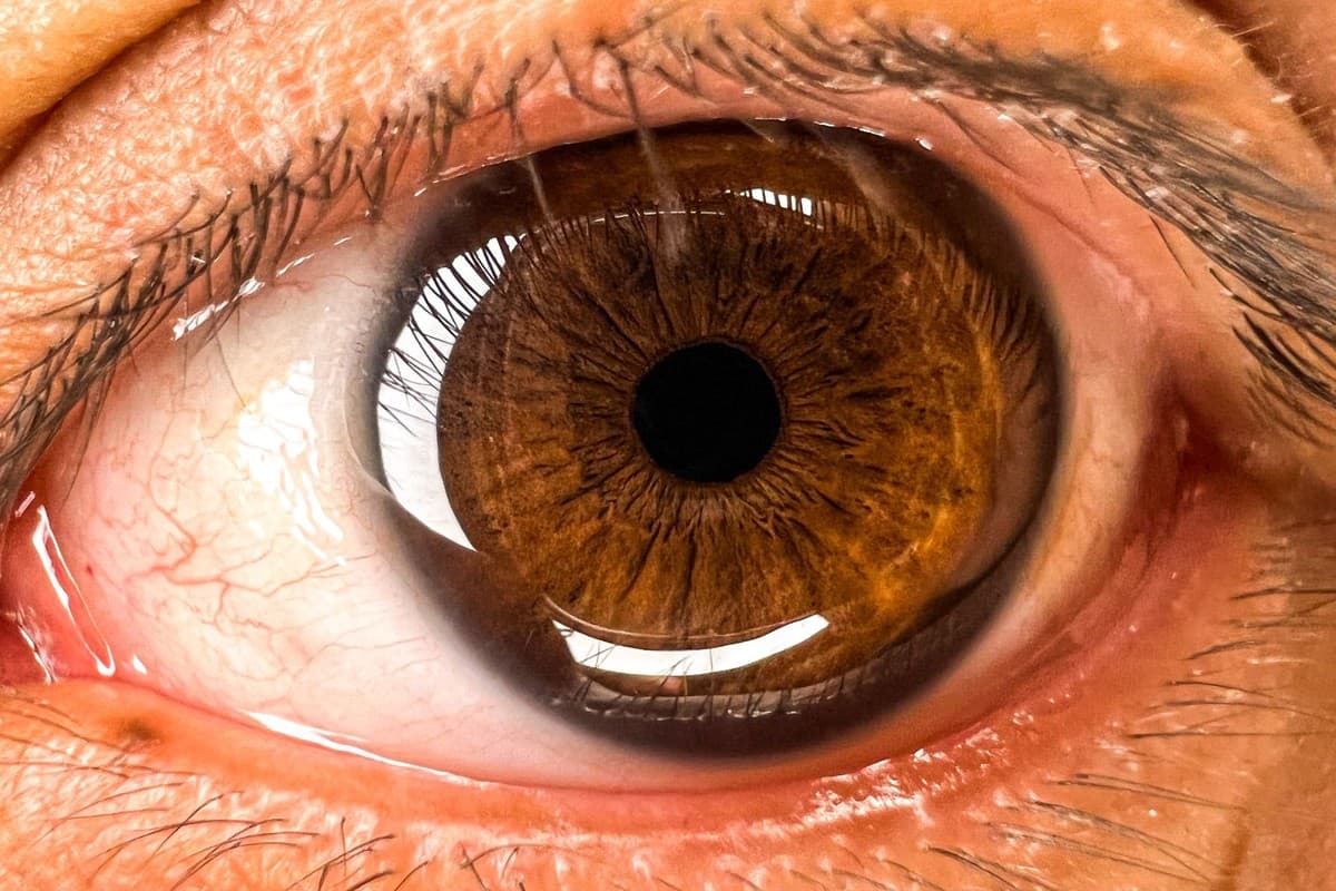 View of the eye and the area of the natural lens