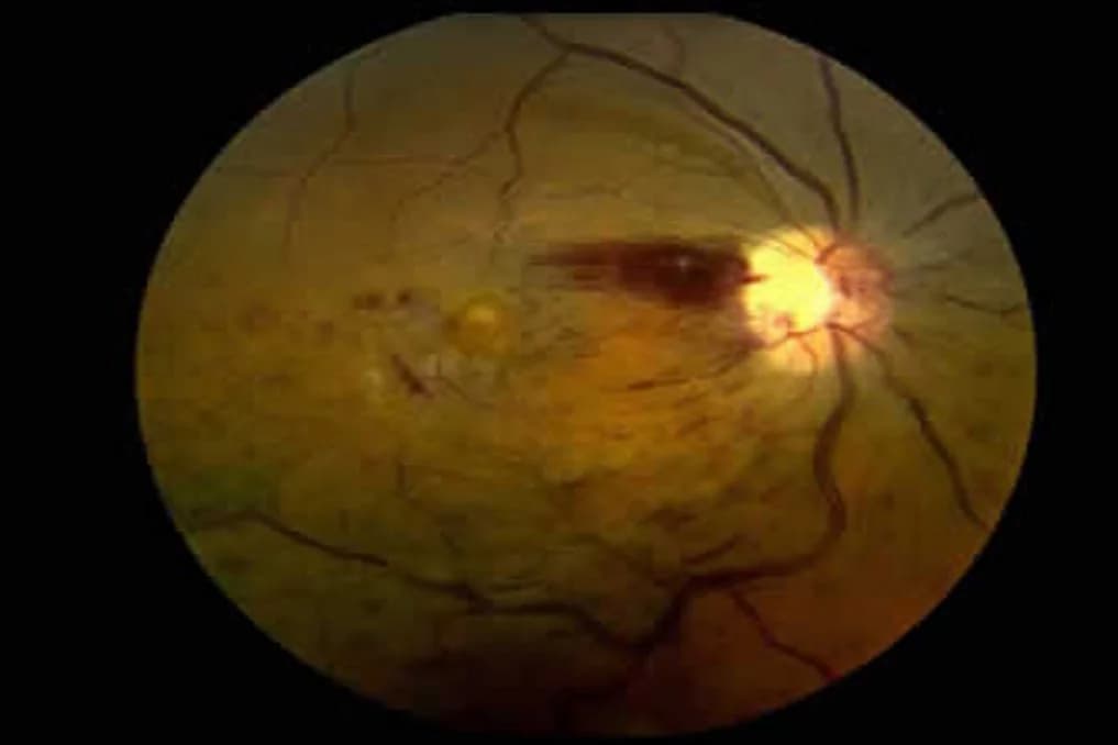 Retinal Vascular Occlusions
