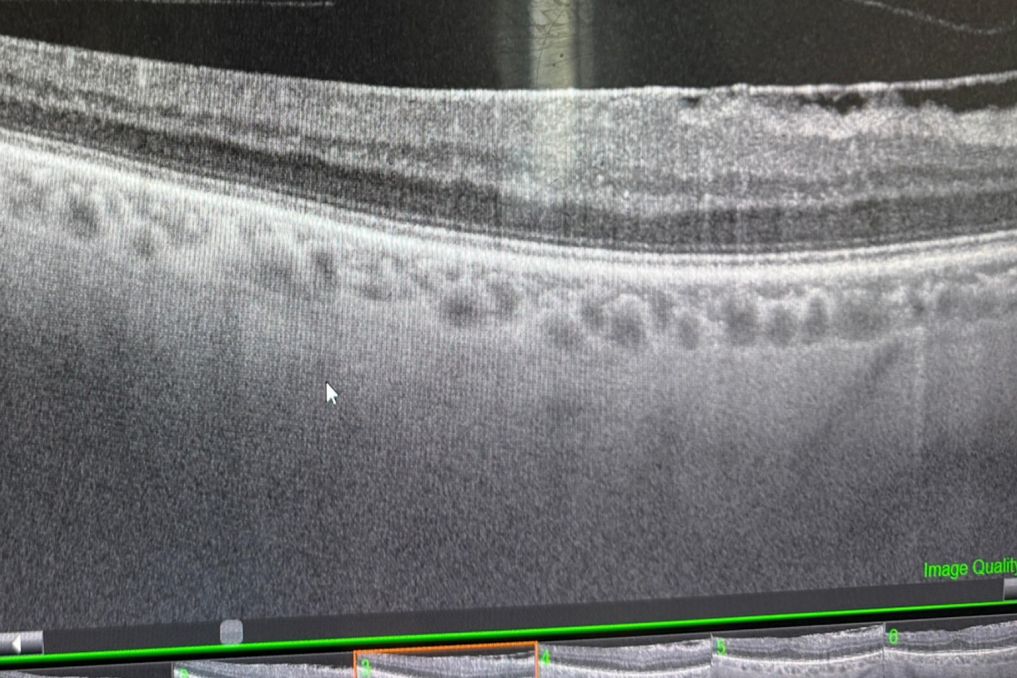 Epiretinal Mebran (ERM)