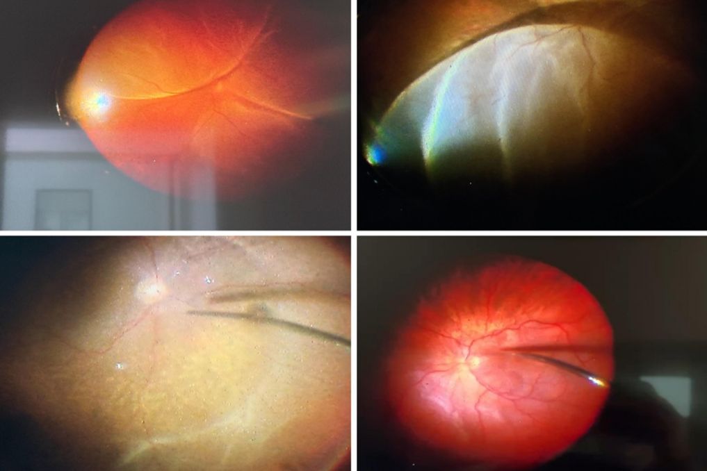Retina Dekolmanı